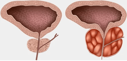 Kaj je prostatitis