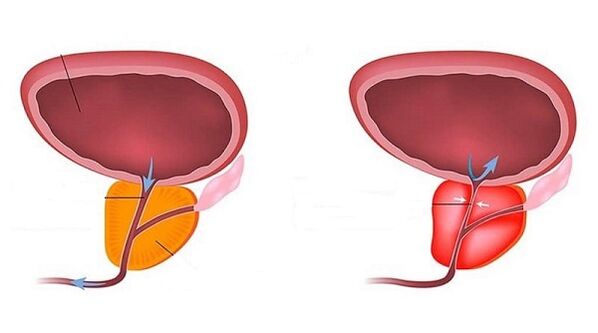 zdrava in vneta prostata s prostatitisom