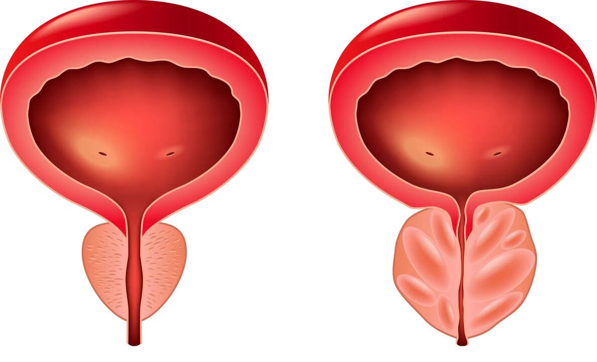 normalna in bolna prostata